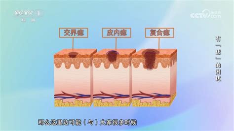 突出來的痣|身上的痣能抠吗？凸起的痣和平平的痣哪个更易恶。